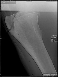 xray fracture 