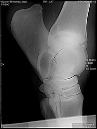 hock xray