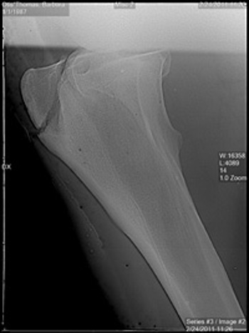 xray fracture 